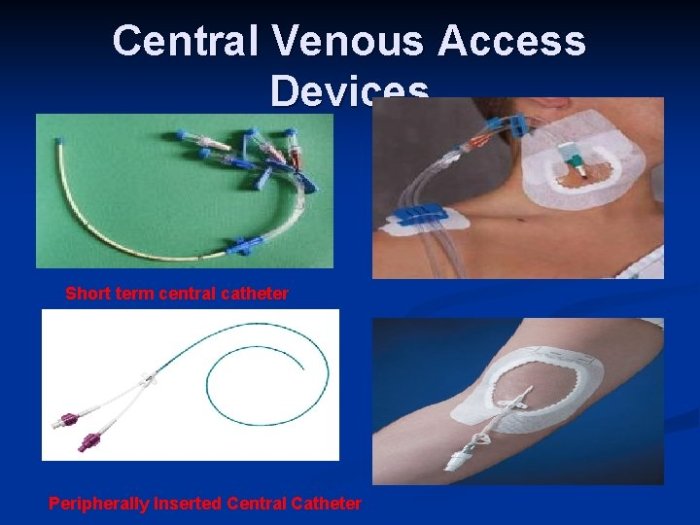 Skills module 3.0 central venous access devices posttest