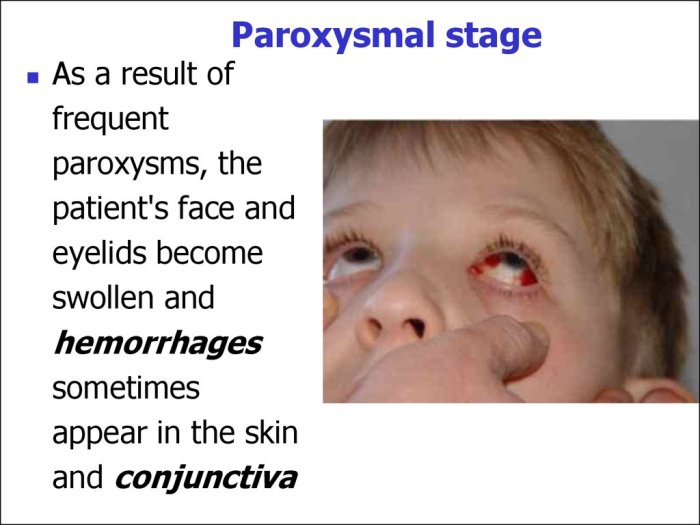 Cough paroxysmal