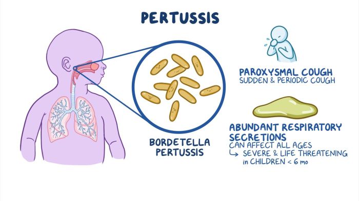 A paroxysmal cough is associated with legionnaires' disease.